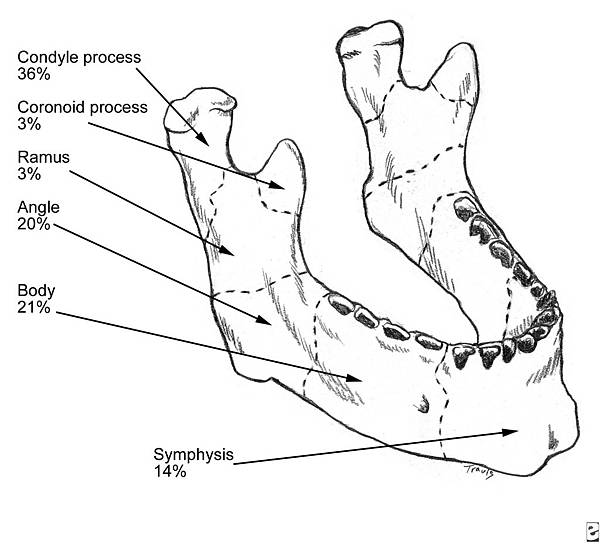 Apologise, but, facial fracture classification variants Are facial fracture classification opinion you