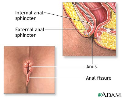 Anal Fissure