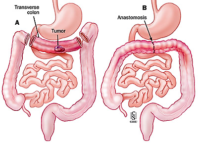 Transverse Colectomy