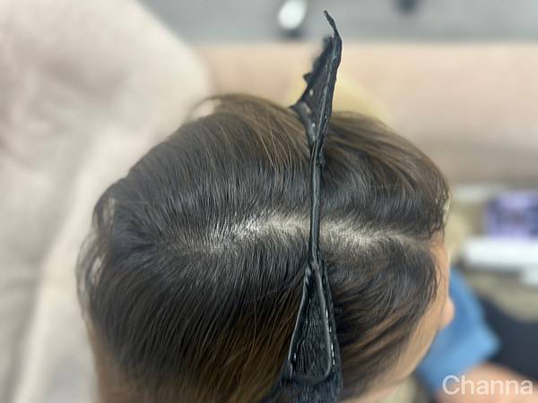 台北內湖 | 育毛粉餅髮際線推薦 > Sheen.希恩美學設