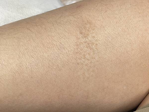 新北蘆洲半永久遮瑕初體驗：身上有疤痕、臉上黑眼圈太重怎麼遮