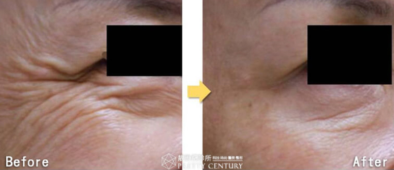 要用的-4-1BOTOX-01.jpg