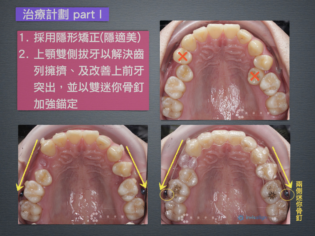 0841209陳弘育 網路行銷用 上顎變化.004.jpeg