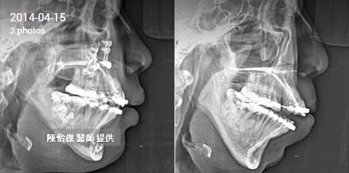 正顎手術治療第二型咬合不良-(暴牙、下巴後縮)-案例