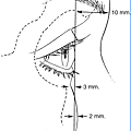 lateral view for cheek