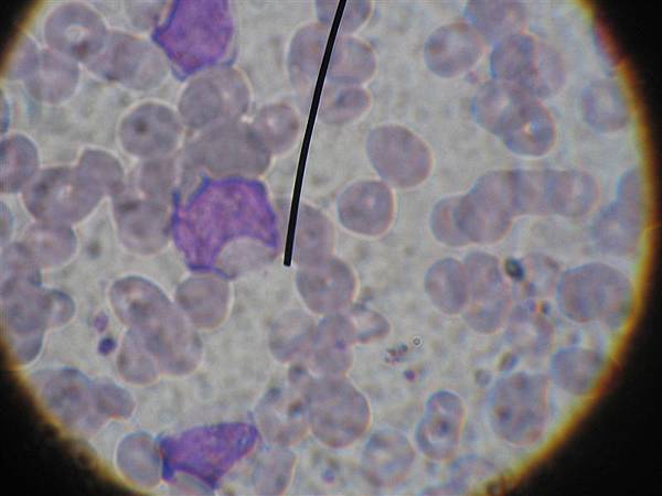 CLL(1)是chronic所以成熟的會比較多、圖譜p492