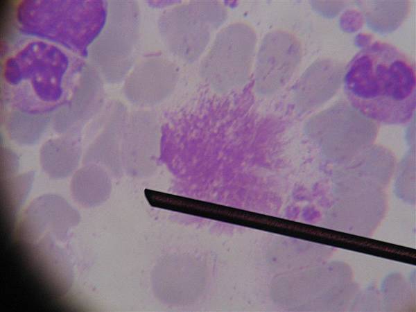 CML(5)~giant platelet