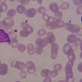 atypical lymphocyte、small lymphocyte