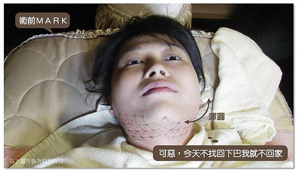 台中電波拉皮|菲仕美診所04 台中電波拉皮|菲仕美診所04