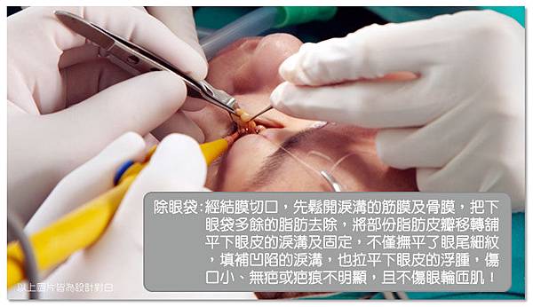 台中眼袋|台中眼袋手術05 台中眼袋|台中眼袋手術05