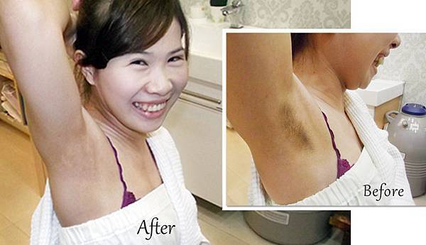 珈妤雷射除毛2.jpg 珈妤雷射除毛2.jpg
