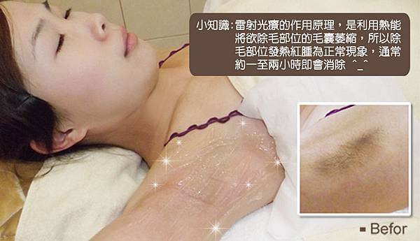 珈妤雷射除毛8.jpg 珈妤雷射除毛8.jpg