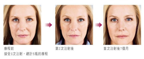 Sculptra案例1.jpg Sculptra案例1.jpg