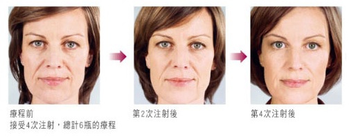Sculptra案例2.jpg Sculptra案例2.jpg