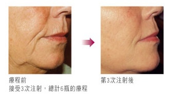 Sculptra案例4.jpg Sculptra案例4.jpg