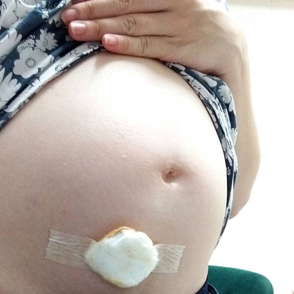 2019-羊膜穿刺.jpg 2019-羊膜穿刺.jpg