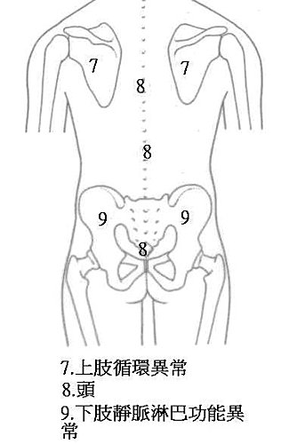 手套式手麻症狀3