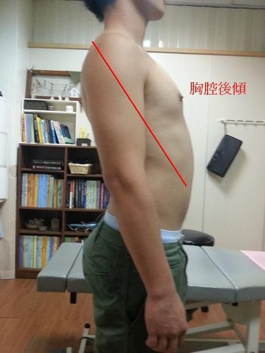 駝背處理 駝背處理