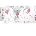徒手治療對於足底筋膜炎2