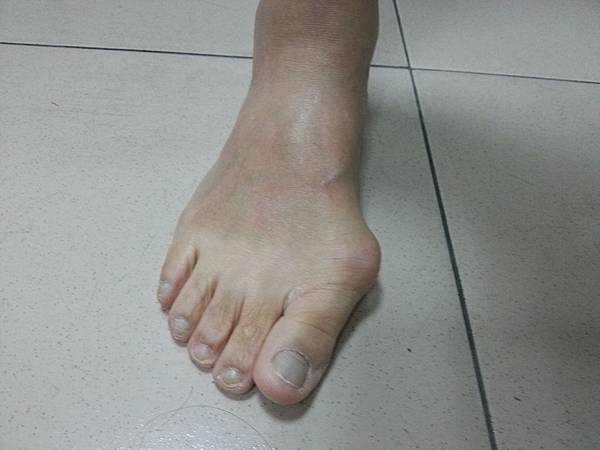 姆指外翻量身鞋墊 姆指外翻量身鞋墊