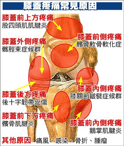 膝蓋疼痛病因多 不見得退化性關節炎.jpg