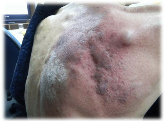  肝的排毒.皮膚長痘痘 蕁麻疹 皮膚過敏 小潔經驗談