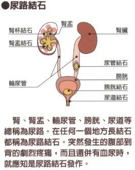 會致命的膽結石 小潔親身體驗