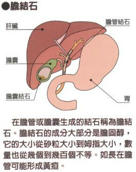 會致命的膽結石 小潔親身體驗