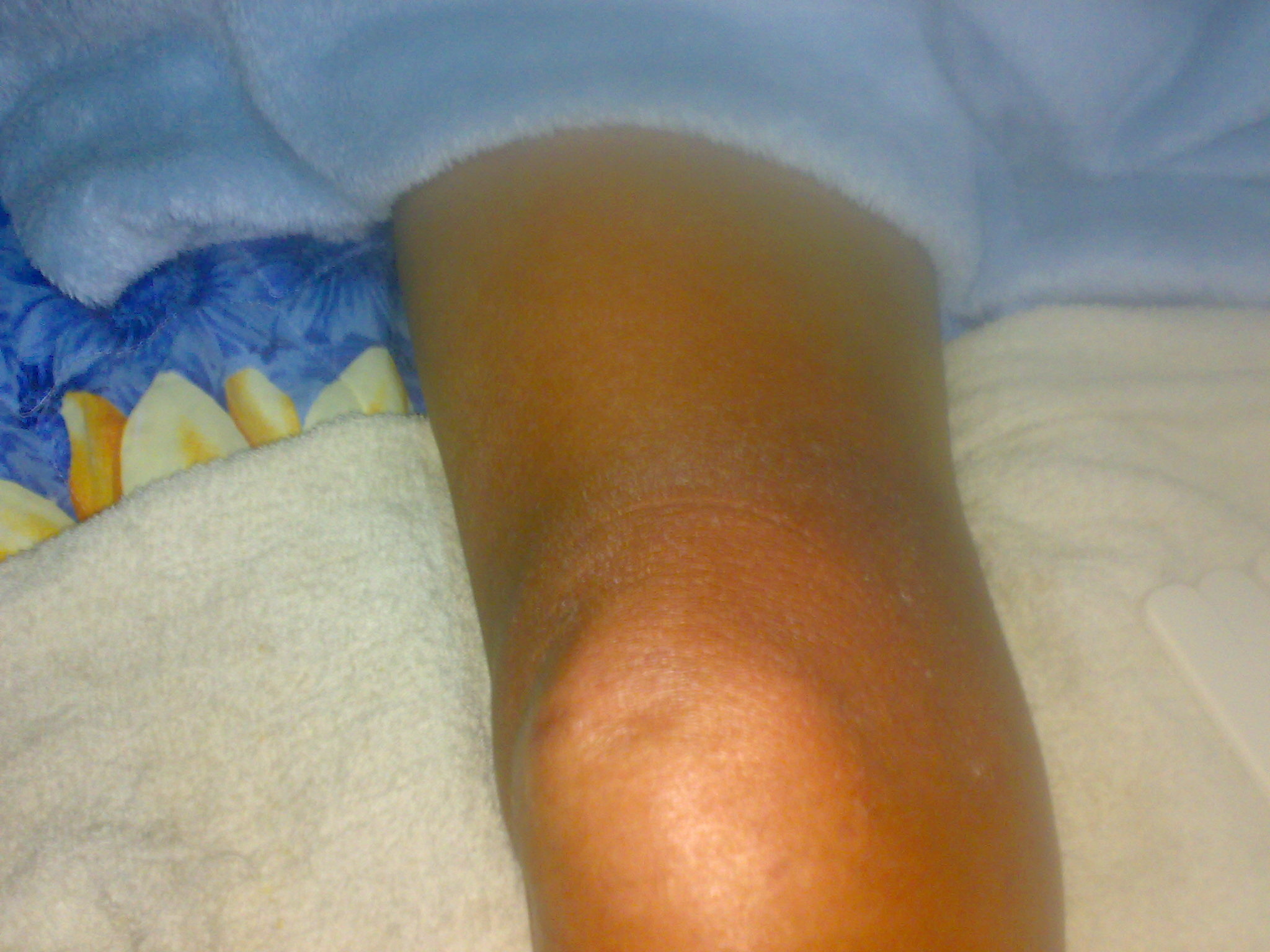 腳底冰冷 膝蓋痠痛 高血壓 靜脈曲張 拍痧 小潔