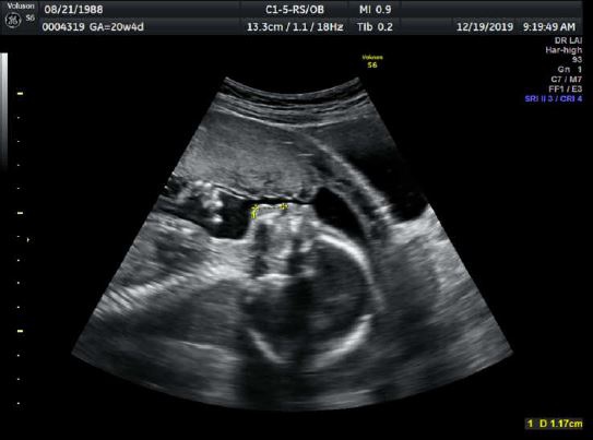 孕期 20w胎兒高層次超音波 胎兒心臟超音波 選擇專業又細心的 孕兒診所 Lu拉拉是對夫妻 痞客邦