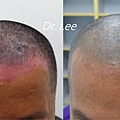 頭皮乾癬進步2.jpg