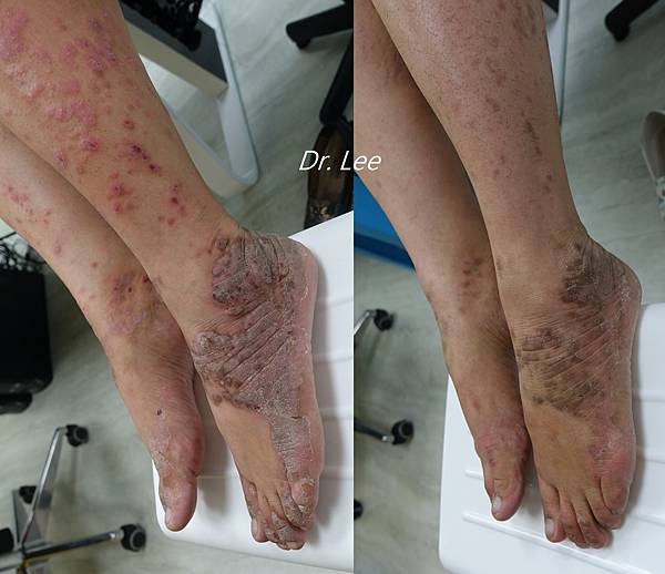 掌蹠型乾癬.jpg 掌蹠型乾癬.jpg