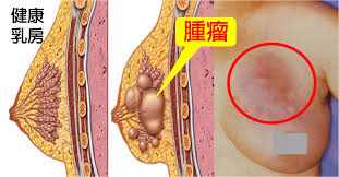 乳房硬塊.jpg