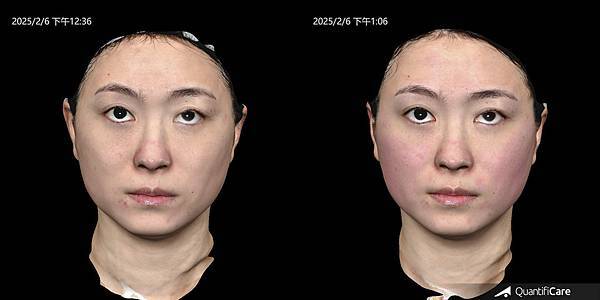 霍普金斯診所│EMFACE 菲斯波：無痛電波非侵入臉部緊實新科技，超越電音波深度，讓熟女也能輕鬆對抗地心吸引力