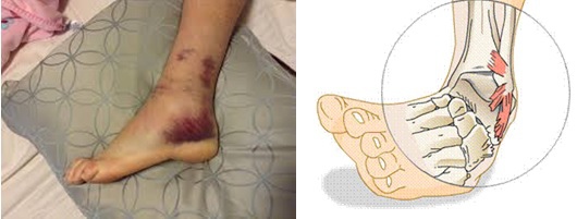 [問題] 以前曾扭傷的腳跑起來有些問題