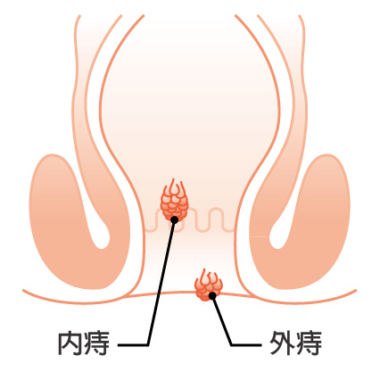 1-4-1-老化的痔瘡血管.jpg