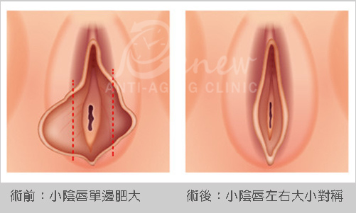 手術