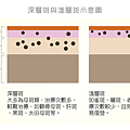 深層斑與淺層斑示意圖-300dpi-01