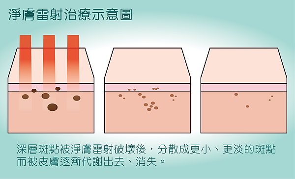 淨膚雷射治療示意圖-01