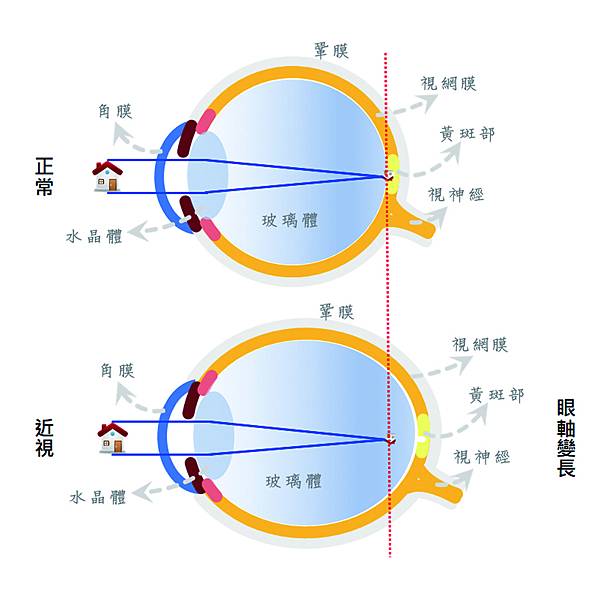 近視VS正常視力眼球