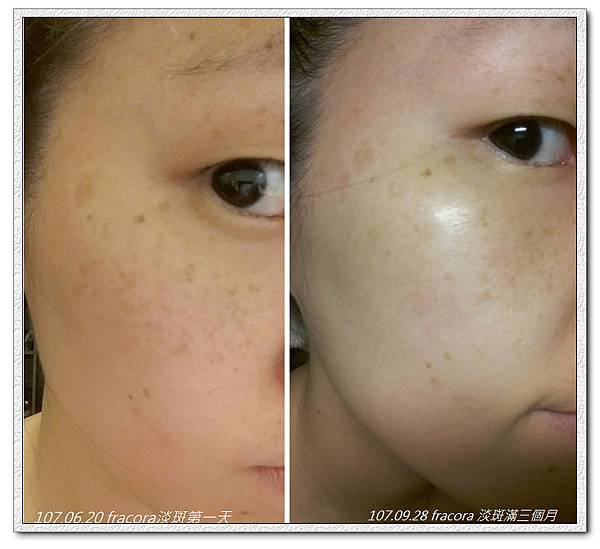 fracora淡斑三個月