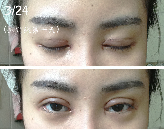 Fifi S 全開式雙眼皮 愛死我的雙眼皮了 超像童話公主的眼睛 里約診所 王冠中醫師 痞客邦