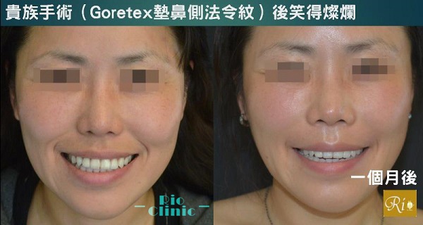 貴族手術 Goretex墊法令紋的理論與實例 里約診所 王冠中醫師 痞客邦