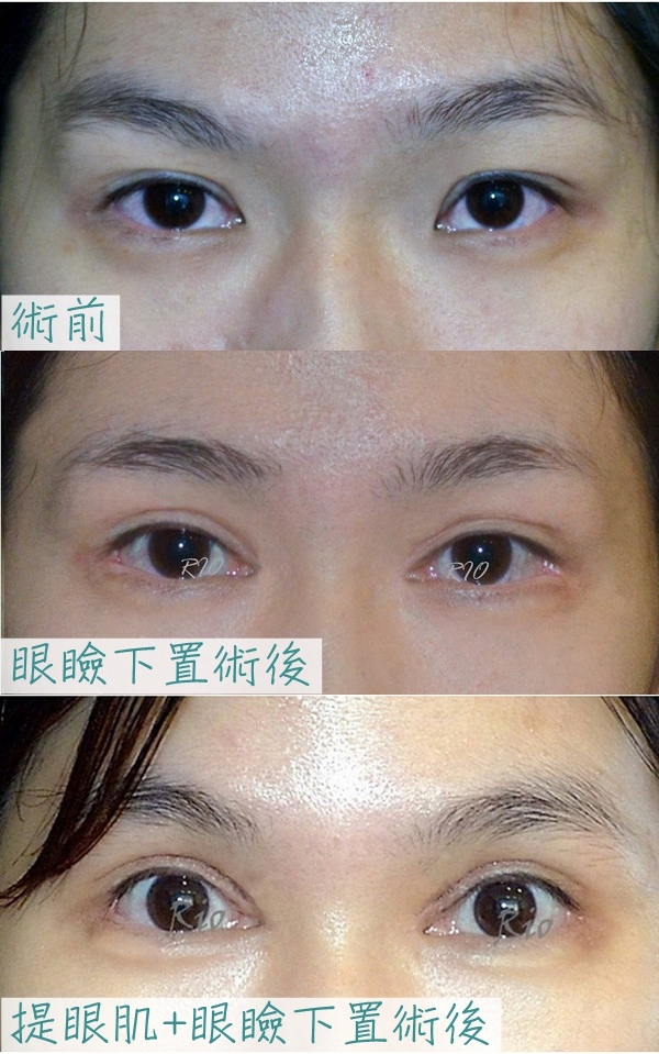 眼部整形 眼尾下置術 探索大眼睛的極限混血眼的最後一毫米 2組案例 里約診所 王冠中醫師 痞客邦