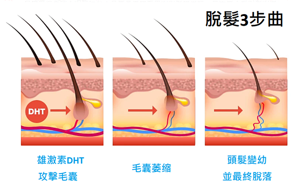 【髮旋脫髮】正常髮旋大小有多大？如何改善髮旋禿？