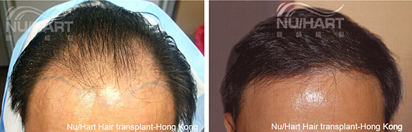 【改善脫髮】藍銅胜肽可以生髮？真的有效果嗎？