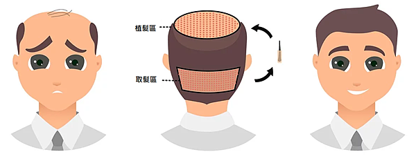 【植髮 vs 紋髮】兩者原理、優缺點一覽