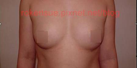 breast a1.jpg