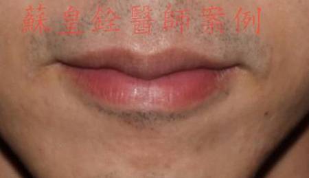 lip9