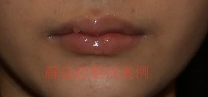 lip5